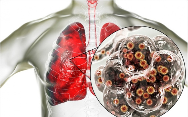 Các hạt li ti của virus SARS-CoV-2 xâm nhập vào phổi. Ảnh: Shutterstock.