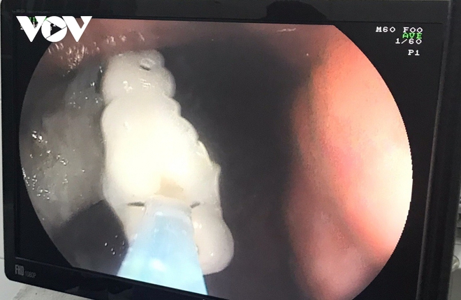 Can thiệp lấy 4 răng giả lạc trong dạ dày của bệnh nhân 61 tuổi - Ảnh 1.
