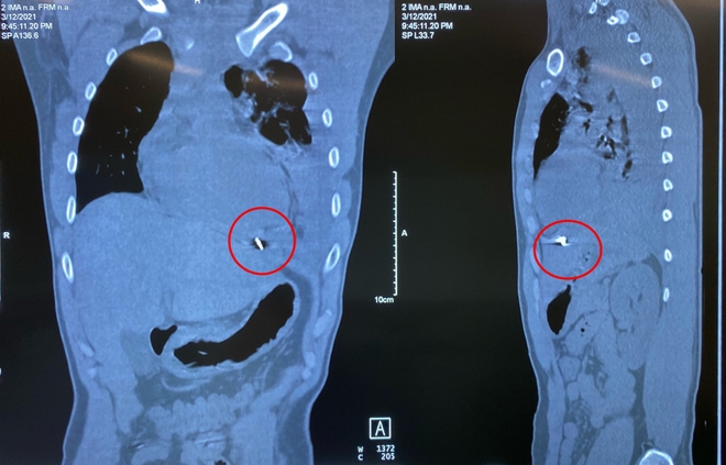 Nam thanh niên bị thủng màng tim do dị vật kim khí bắn vào ngực trái - Ảnh 2.