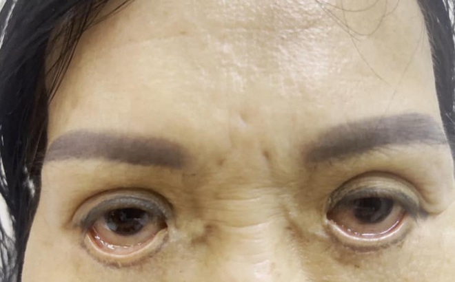 Mắt người phụ nữ trợn ngược sau cắt mí tại cơ sở spa