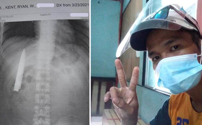 Người đàn ông Philippines choáng váng khi phát hiện lưỡi dao găm trong ngực. Ảnh: OC