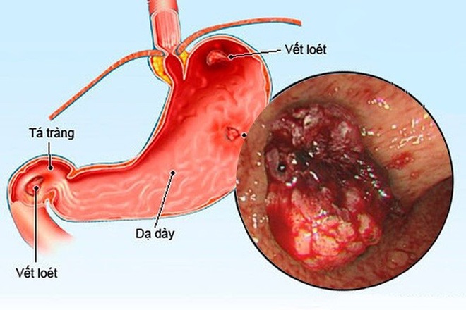 Phụ thuộc corticoid - bài học đắt giá - Ảnh 1.