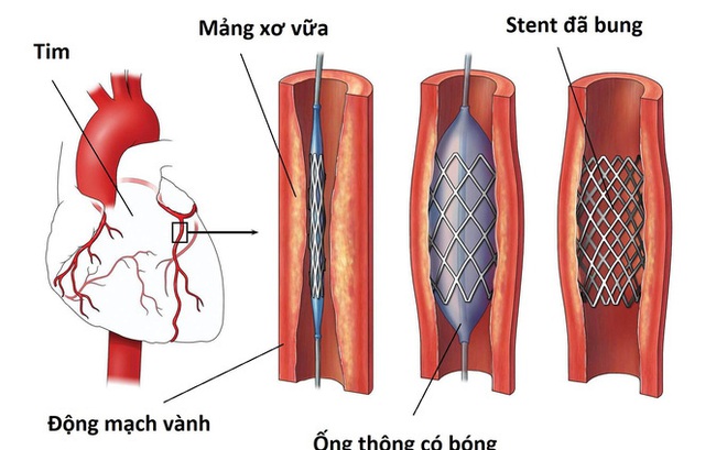 Đặt stent mạch vành được áp dụng khi thiếu máu cơ tim nặng hoặc có nguy cơ nhồi máu do mảng xơ vữa - Ảnh minh hoạ