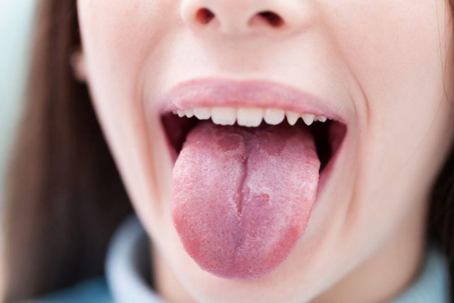 Những nguyên nhân khiến lưỡi bạn sưng đau - Ảnh 3.