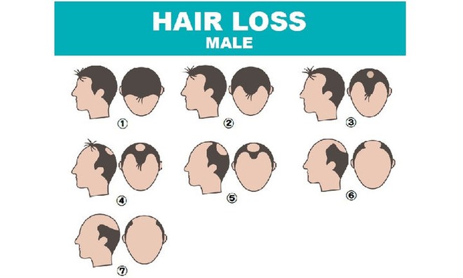 Có cách nào chữa được rụng tóc, hói đầu không? Bác sĩ khuyên nên bắt đầu từ 4 nguyên nhân - Ảnh 2.