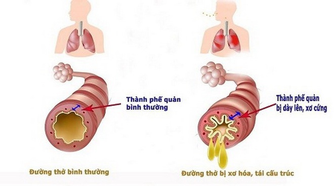 Tìm ra căn nguyên gây bệnh viêm đường hô hấp mạn tính - Ảnh 3.