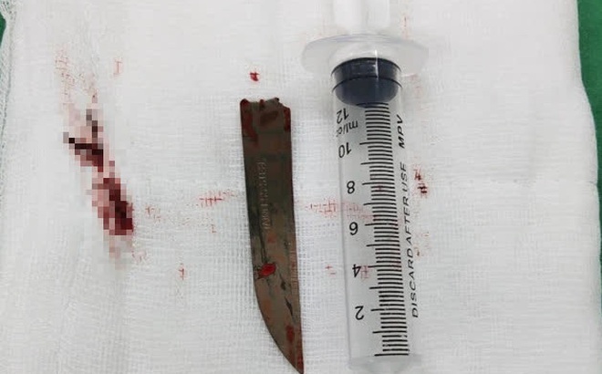 Các BS lấy lưỡi dao nhọn ra khỏi lưng bệnh nhân.
