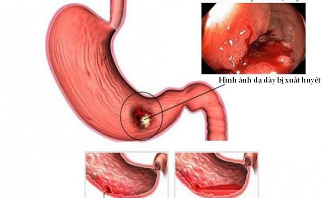 Nhận biết sớm xung huyết dạ dày - Ảnh 1.