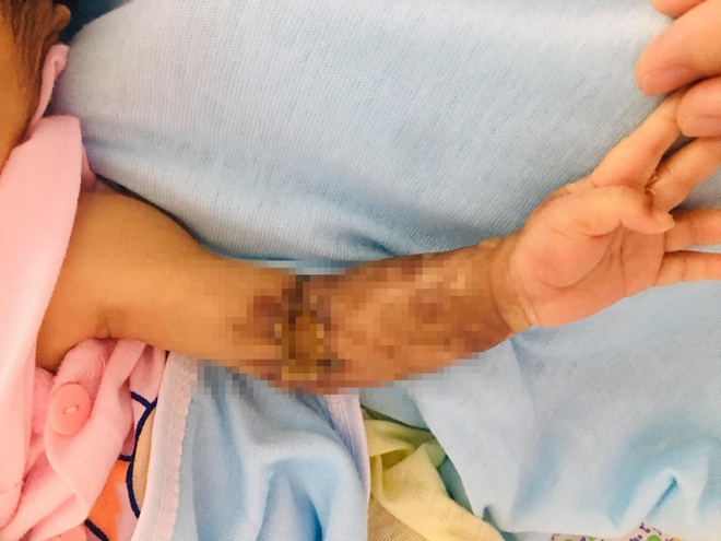 Bé trai 1 tháng tuổi bị hoại tử cánh tay do mắc hội chứng chèn ép khoang - Ảnh 1.