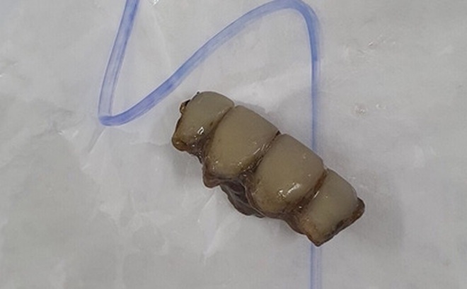 Hàm răng giả 4 cái được các BS lấy ra khỏi phế quản bệnh nhân.