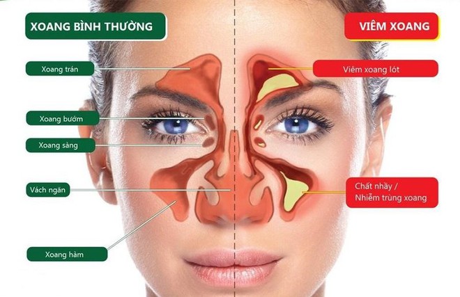 Đừng nhầm viêm xoang với viêm mũi dị ứng! - Ảnh 2.