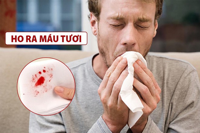 Thêm 1 triệu chứng Covid-19 mới: Bệnh nhân ho ra máu; Thế giới ghi nhận gần 3,8 triệu người chết - Ảnh 1. Thêm 1 triệu chứng Covid-19 mới: Bệnh nhân ho ra máu; Thế giới ghi nhận gần 3,8 triệu người chết - Ảnh 1.