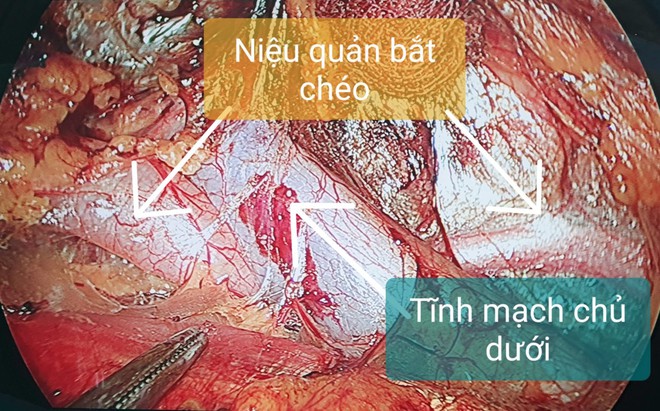 Đau tức thắt lưng: Coi chừng dị tật hệ tiết niệu! - Ảnh 2.