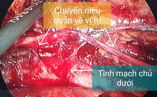 Đau tức thắt lưng: Coi chừng dị tật hệ tiết niệu! - Ảnh 3.