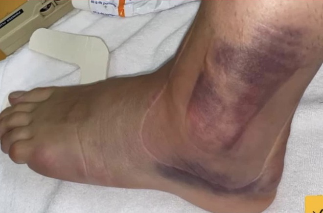 1 ngày sau chấn thương kinh hoàng của Ceballos: Cổ chân bầm tím, sưng tấy gây sợ hãi - Ảnh 2.