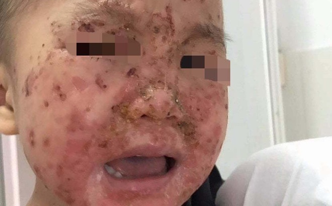 Bé trai toàn thân chốc lở,, mưng mủ, đóng vẩy do thói quen triệu bà mẹ vẫn làm mỗi ngày (ảnh BVCC)