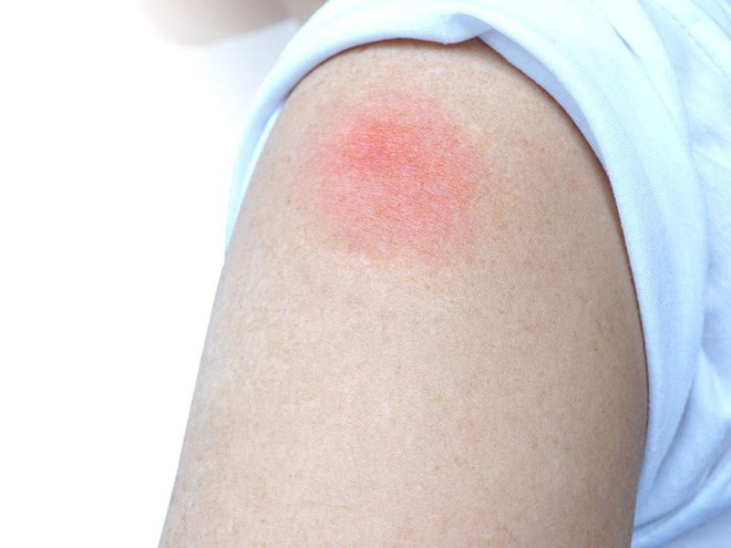 Phản ứng “cánh tay COVID-19” sau tiêm vaccine có đáng ngại? - Ảnh 2.