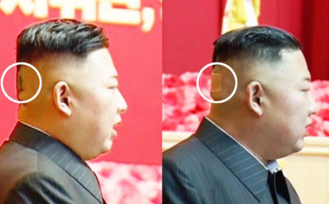 Miếng băng dán ở sau đầu ông Kim Jong-un. Ảnh: Twitter