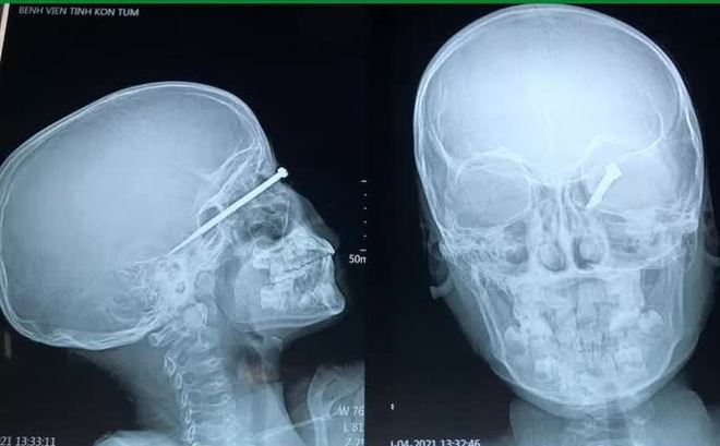 Hình ảnh mũi tên găm sâu trong đầu bệnh nhi 8 tuổi - Ảnh Hà My