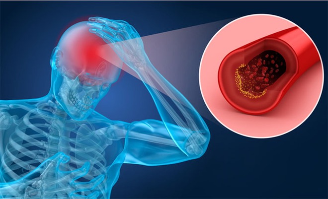 4 thói quen hàng ngày gây thiếu máu não dễ bị bỏ qua - Ảnh 1.