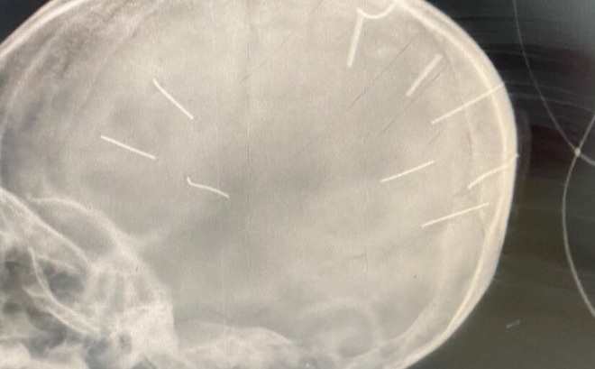 Hình ảnh chụp X-quang sọ não bé gái 3 tuổi cho thấy 9 chiếc đinh bắn vào não. (Ảnh: Bệnh viện cung cấp)