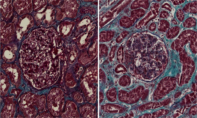 Virus SARS-CoV-2 tấn công thận và hình thành sẹo - Ảnh 1.