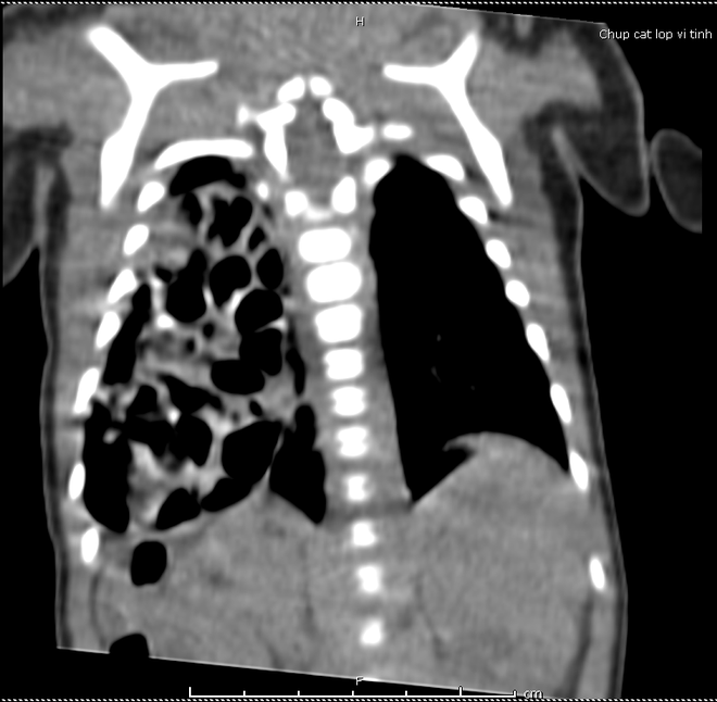 Gan ruột chui lên ngực, trẻ có thể chết ngay sau ít phút chào đời - Ảnh 2.
