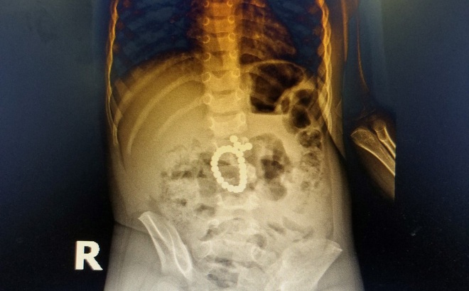 Hình ảnh chụp Xquang cho thấy vòng chuỗi hạt nằm trong bụng cháu bé.