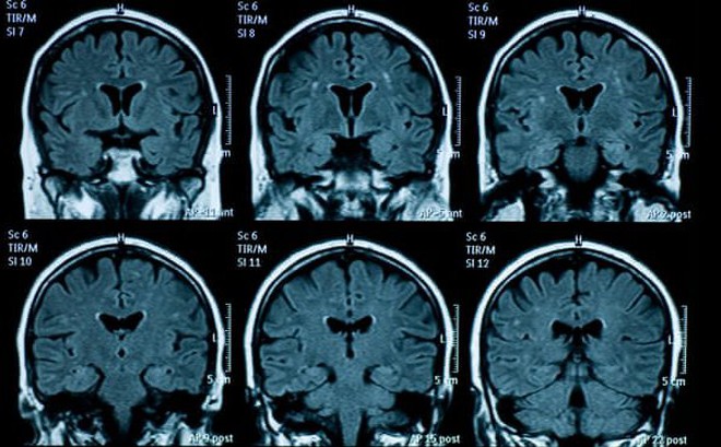 Sự khác biệt về tuổi của não bộ là khoảng 3 năm. Ảnh: Getty Images