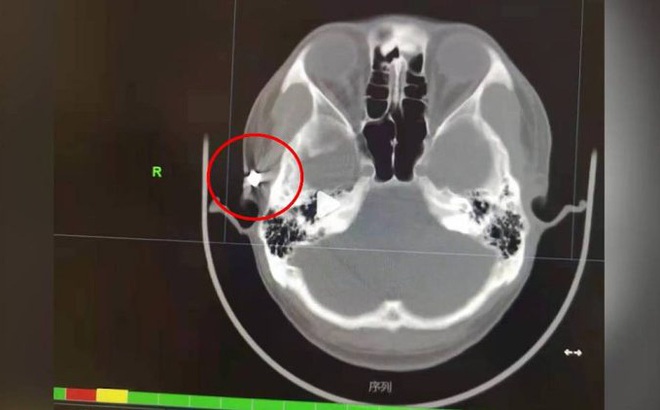 Viên đạn nằm gần thái dương của người đàn ông. Ảnh: O.C