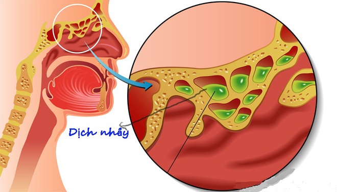 8 biện pháp làm giảm ngạt mũi cho F0 - Ảnh 2.