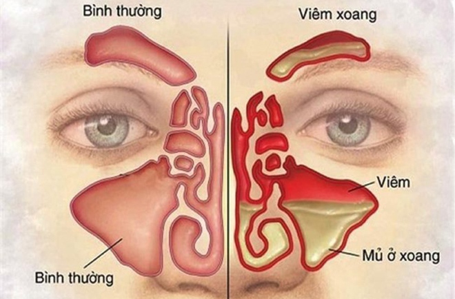 15 cách chữa viêm xoang tại nhà hiệu quả, tiết kiệm - Ảnh 1.