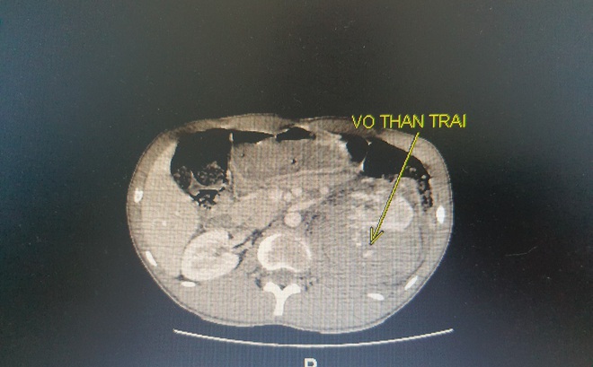 Hình ảnh phim chụp thận bị vỡ của bệnh nhân, ảnh BSCC.