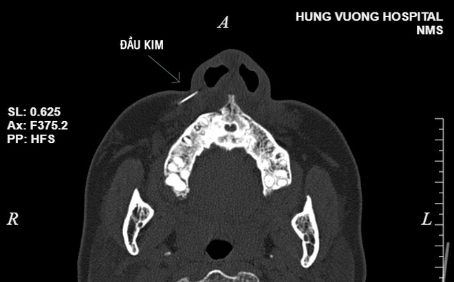 Hình ảnh phim chụp cây kim trong má bệnh nhân.