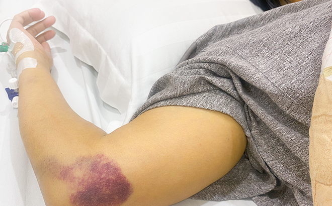 Bệnh nhân bị xuất huyết da niêm mạc ở vùng cánh tay do xơ gan giai đoạn cuối gây ra. Ảnh: Nguyễn Trăm.
