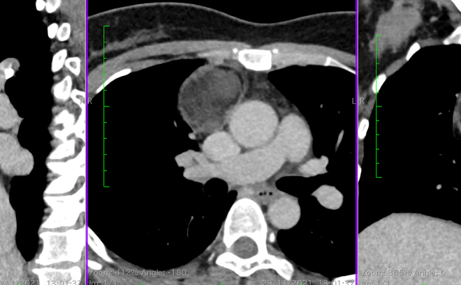 Hình ảnh khối "u quái" trên phim chụp CT phổi. Ảnh: BVCC.