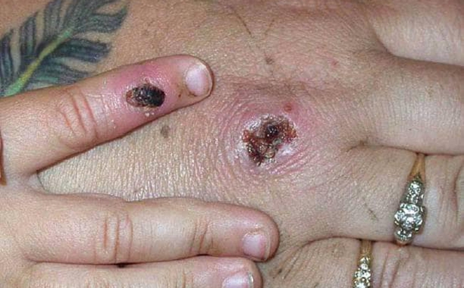 6 người Campuchia đều xuất hiện các triệu chứng đáng ngờ như nổi mụn nước trên da tay, chân và mặt. Ảnh: Bộ Y tế Campuchia