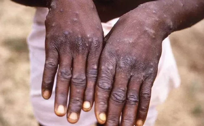 Tính từ đầu năm 2022 đến nay trên thế giới đã có hơn 5.000 người mắc bệnh đậu mùa khỉ. Ảnh: Reuters.