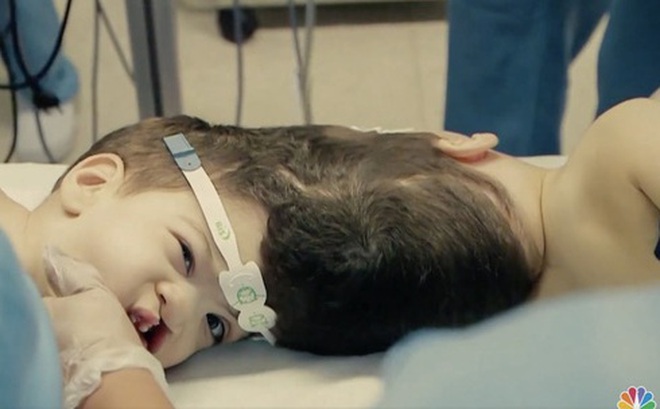 Cặp song sinh 4 tuổi Arthur và Bernardo Lima trong phòng mổ trước ca phẫu thuật ở Rio de Janiero. (Ảnh: NBC News)