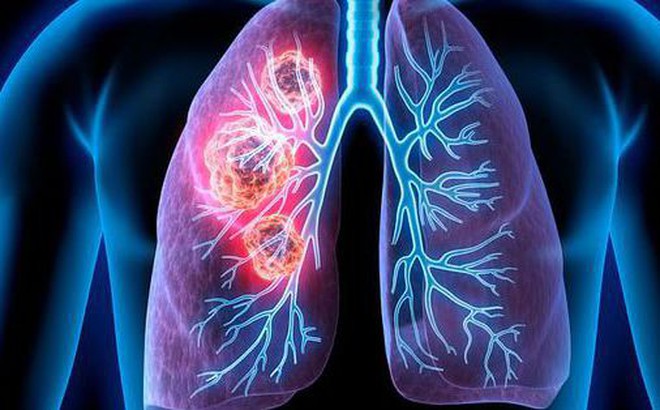 Ung thư phổi, ảnh nguồn Internet.