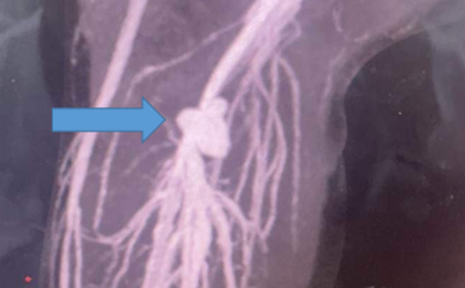 Hình ảnh CT cho thấy túi phình mạch máu lớn, gây cản trở tưới máu chi. Ảnh: BVCC