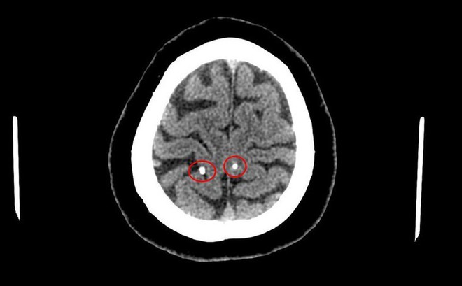 Hình ảnh nang ký sinh trùng trong não người bệnh.