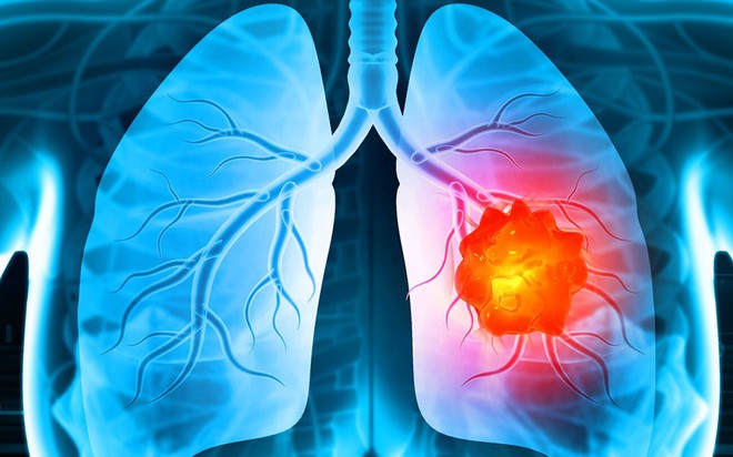 Hình ảnh mô phỏng ung thư phổi (Ảnh: Internet)
