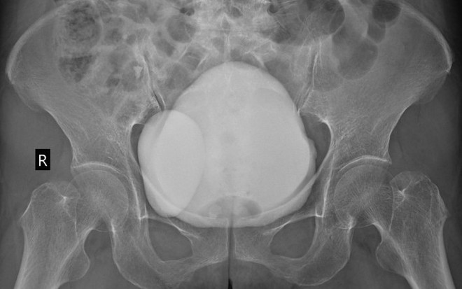 Hình ảnh phim chụp CT ổ bụng cho thấy bệnh nhân có 2 bàng quang (ảnh BSCC).