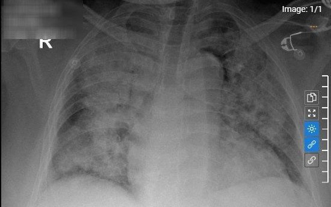 Phim chụp phổi trắng xóa của bệnh nhân (Ảnh: BVCC).
