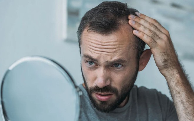 5 Thói Xấu Khiến Tóc Rụng Lả Tả, Chẻ Ngọn, Xơ Yếu: Số 1 Nam Giới Rất Hay Mắc 1 Rung Toc 17555059141621669633168 0 0 741 1186 Crop 17555059193441932643835