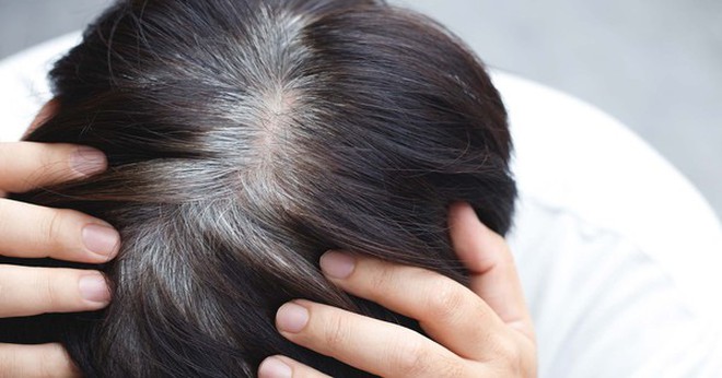 Tóc bạc sớm là nỗi ám ảnh của nhiều người (Ảnh minh họa).