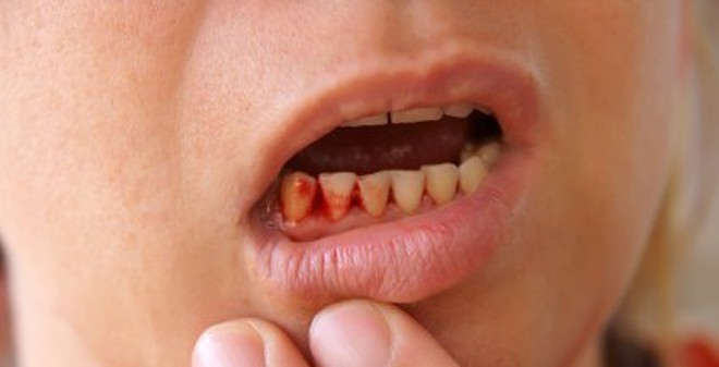 Image result for Cách chữa chảy máu chân răng, viêm lợi cực hiệu quả