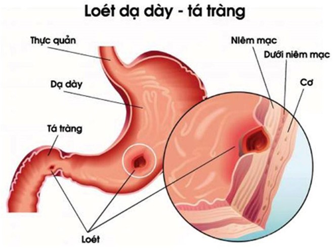 Cảnh báo nguy cơ viêm loét dạ dày tăng cao khi trời chuyển mùa - Ảnh 1.