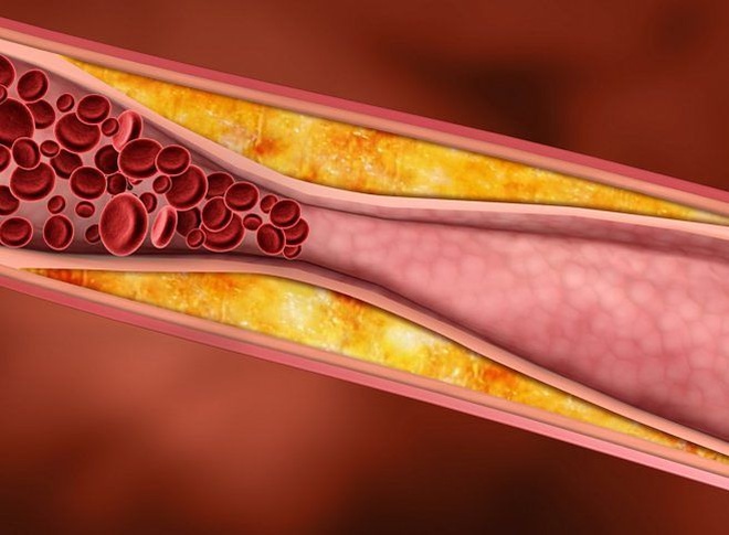 3 dấu hiệu của mỡ máu - căn bệnh giết người âm thầm: Dù gầy hay béo